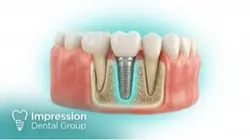 Implants surgery