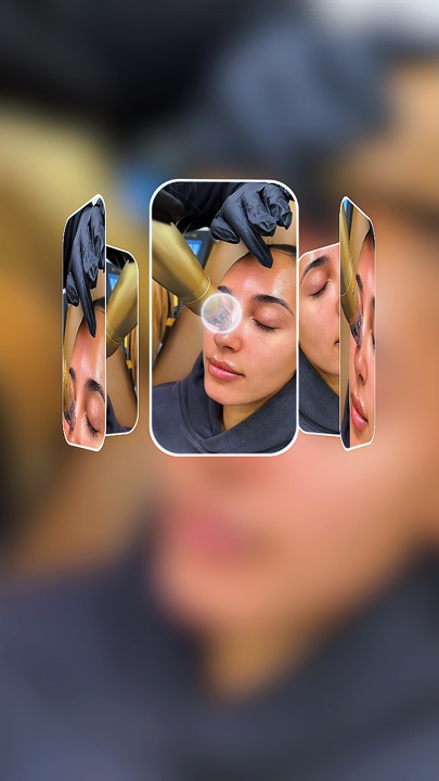 Microneedling 
