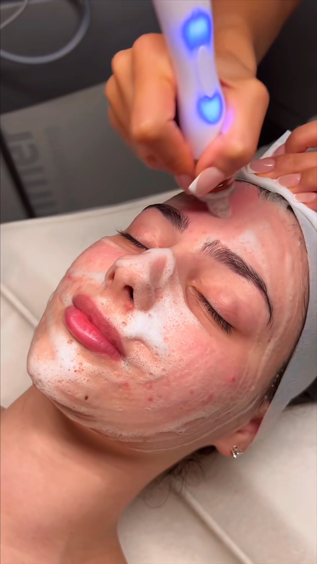 Microneedling