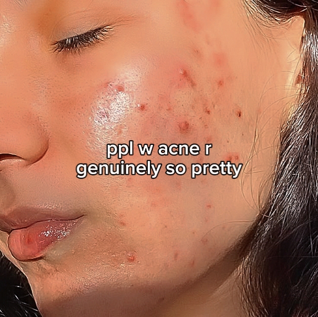 ppl w acne r pretty