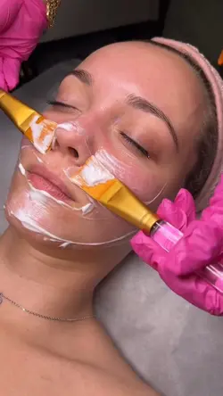 Microneedling aesthe