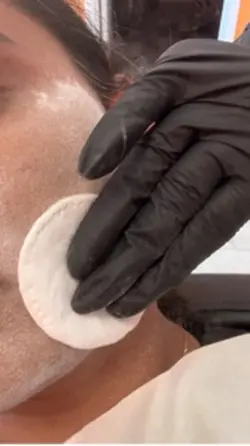 Sugaring hair remova