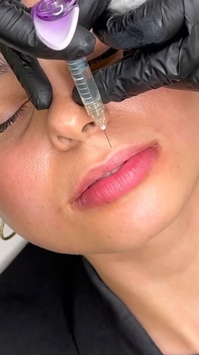 Preenchimento labial
