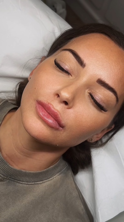 Lip filler