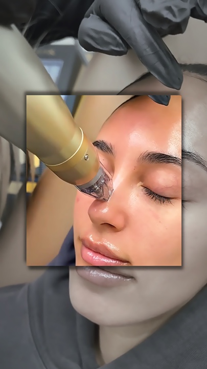 Microneedling 