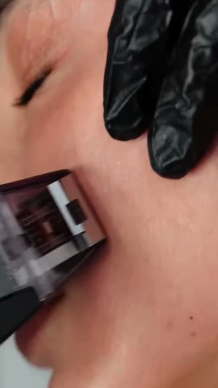 Microneedling esthétique