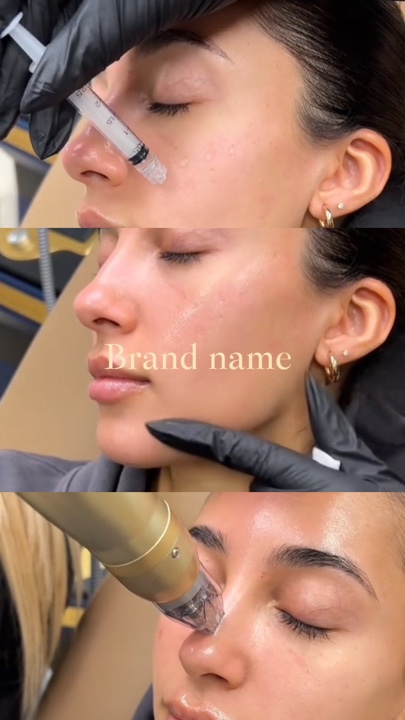 Microneedling