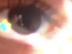 Eye