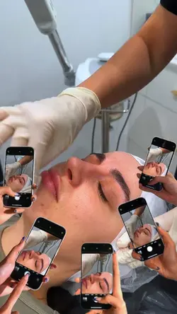 Microneedling aesthe