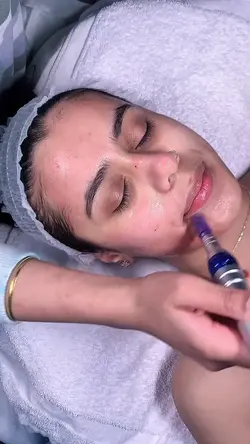 Microneedling aesthe