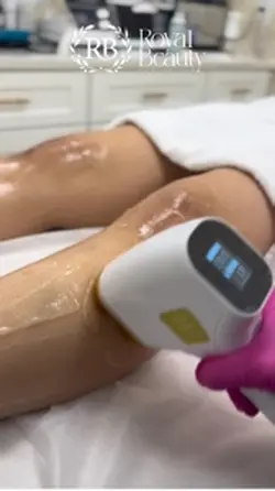 Laser hair removal