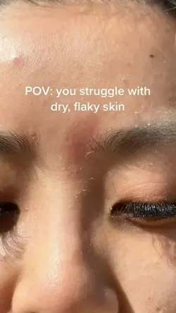 DRY SKIN