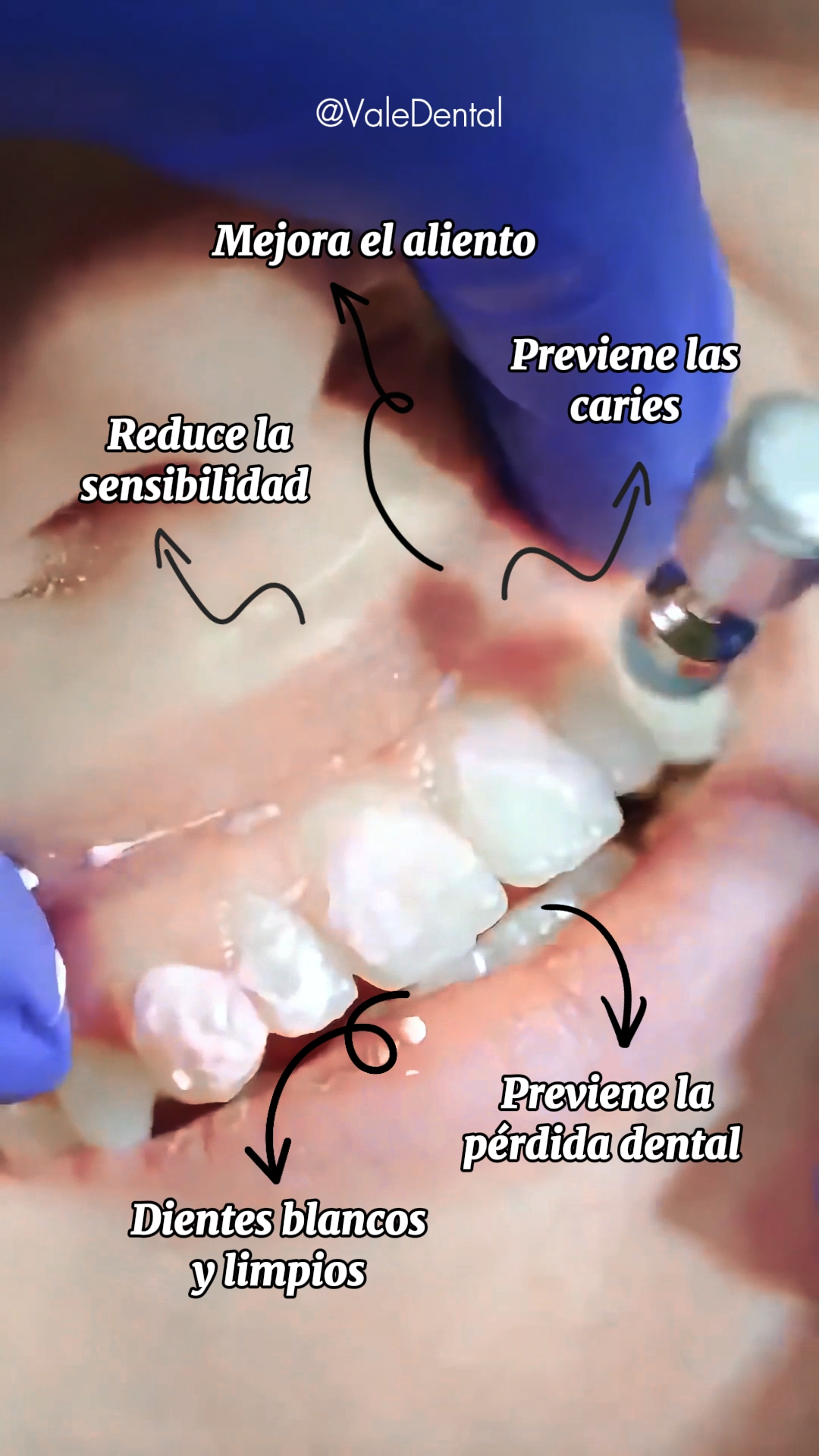 LIMPIEZA DENTÁRIA