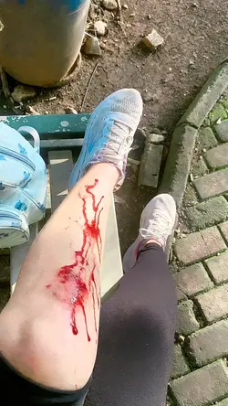 INJURY PRANK