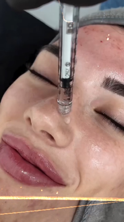 Microneedlingaesthet
