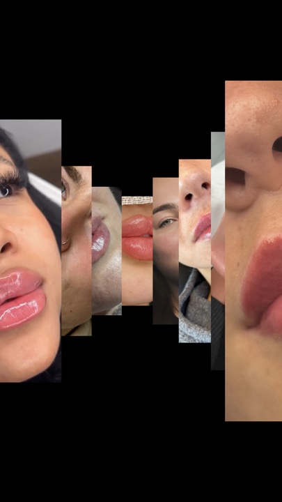 Lippenfüller
