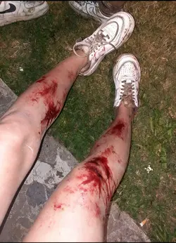 injury prank