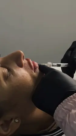 Preenchimento Labial