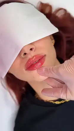 Lip filler