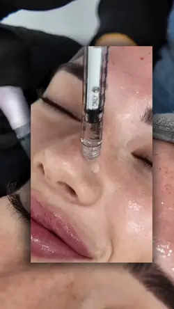 Microneedlingaesthet