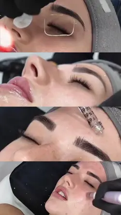 Microneedlingaesthet