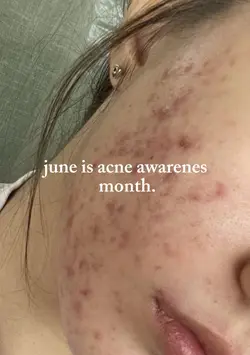 acne awareness 