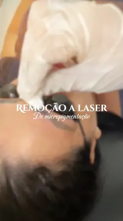 Remoção a laser
