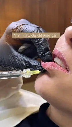 Antes Depois Labial