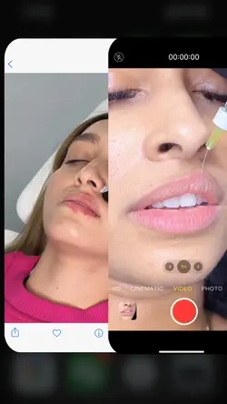 Lip filler
