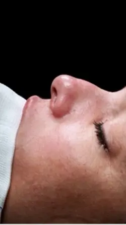 Rinoplastia 