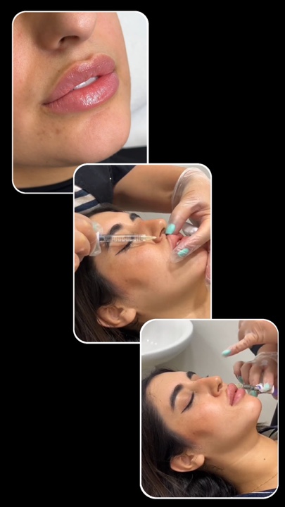 Relleno de labios