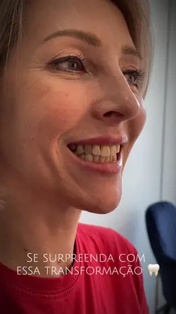 Antes e depois dente