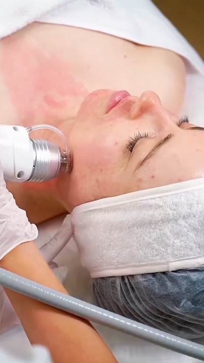Microneedling