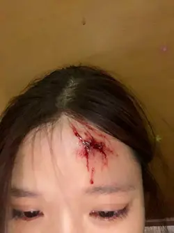 prank injury effect