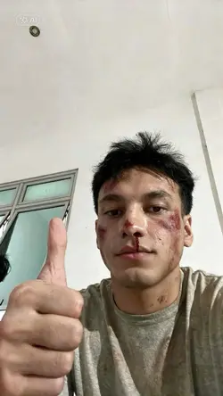 ai luka wajah