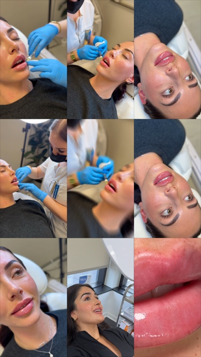 Relleno de labios