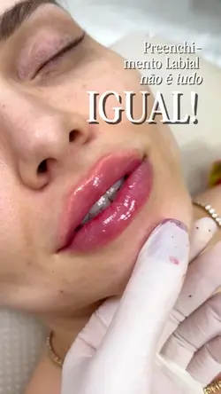 Preenchimento labial