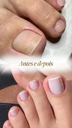Antes e depois nail 