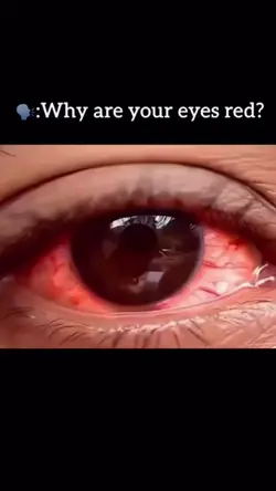 Eyes Red