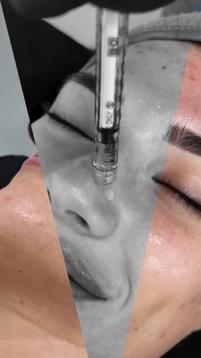 Microneedlingaesthet