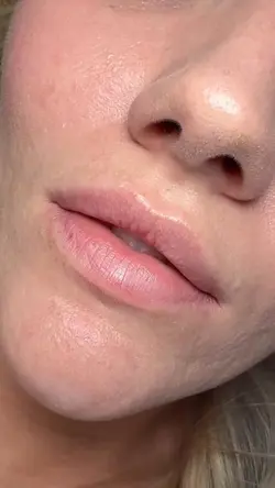 Lip filler