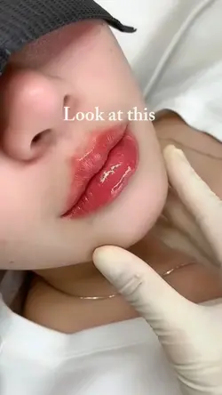 Lip filler