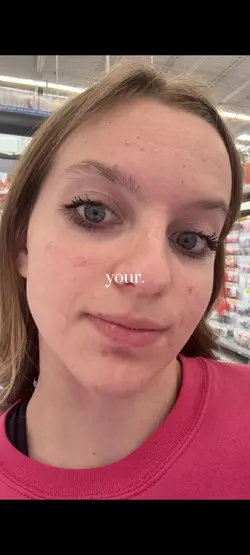 my acne 4 months ago