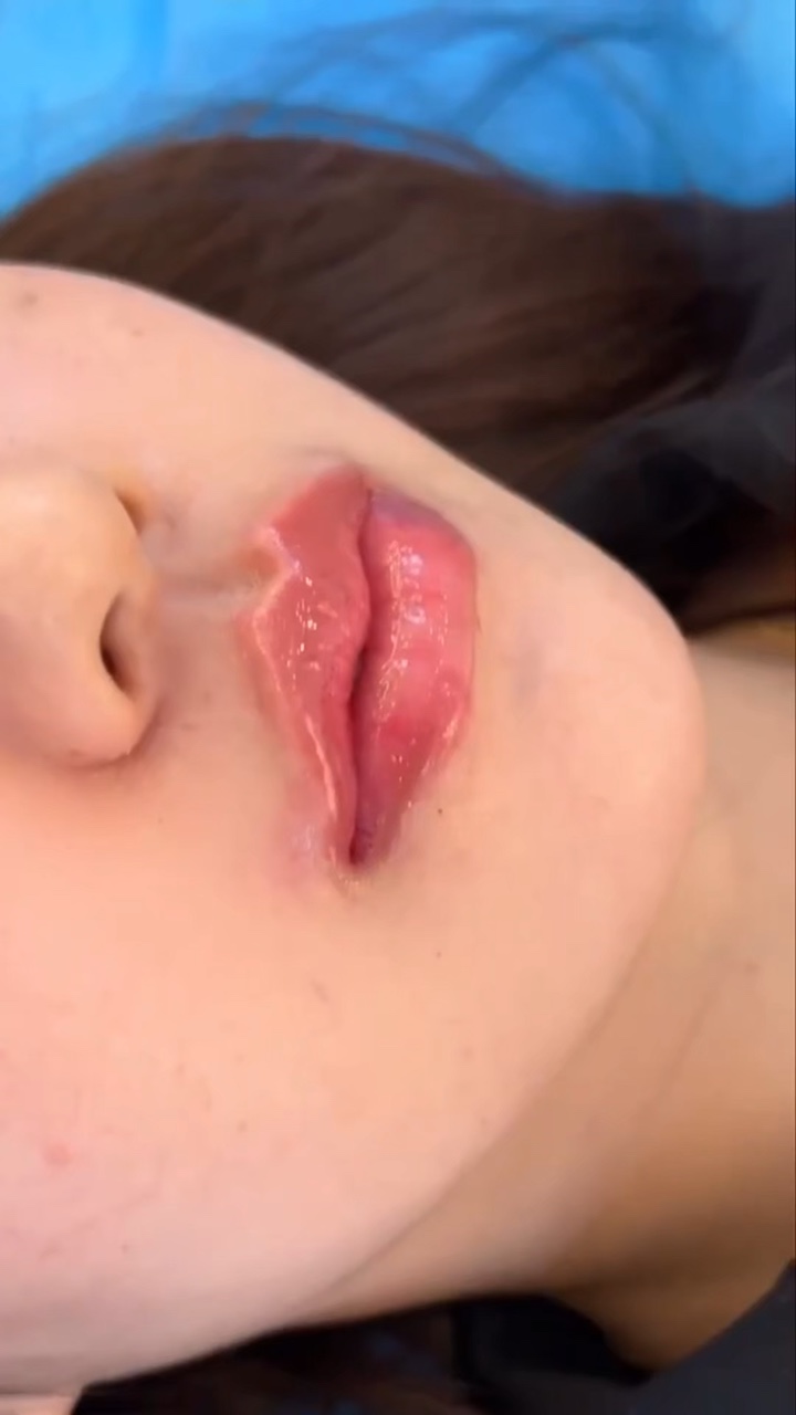 Lippenfüller