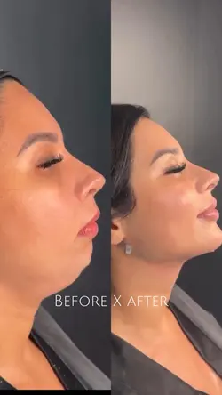 Lipo | Estetica