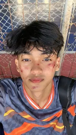 prank injury 