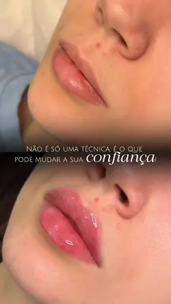 Antes e depois lábio