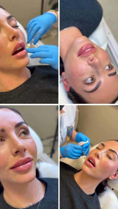 Lip filler