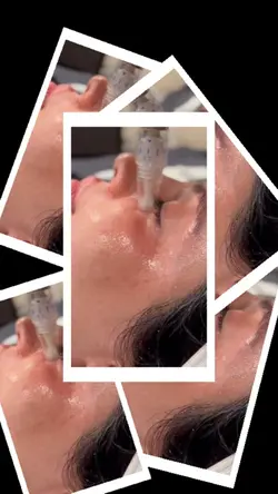 Microneedling aesthe