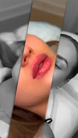 Lip filler